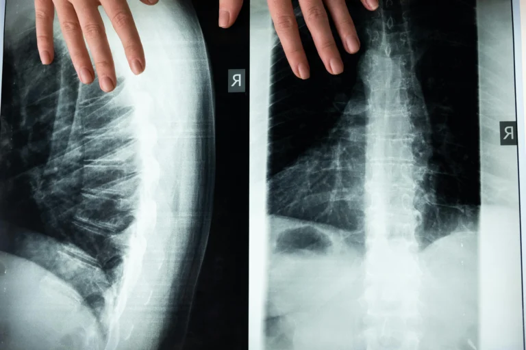 Kyphoplasty vs Vertebroplasty Explained
